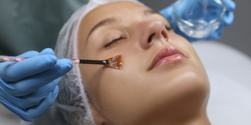 Chemical Peel Treatment Oakville