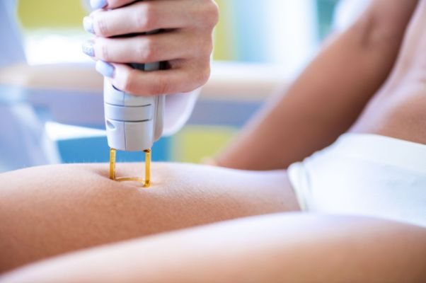 Laser Hair Removal – Medium Area Oakville Clinic