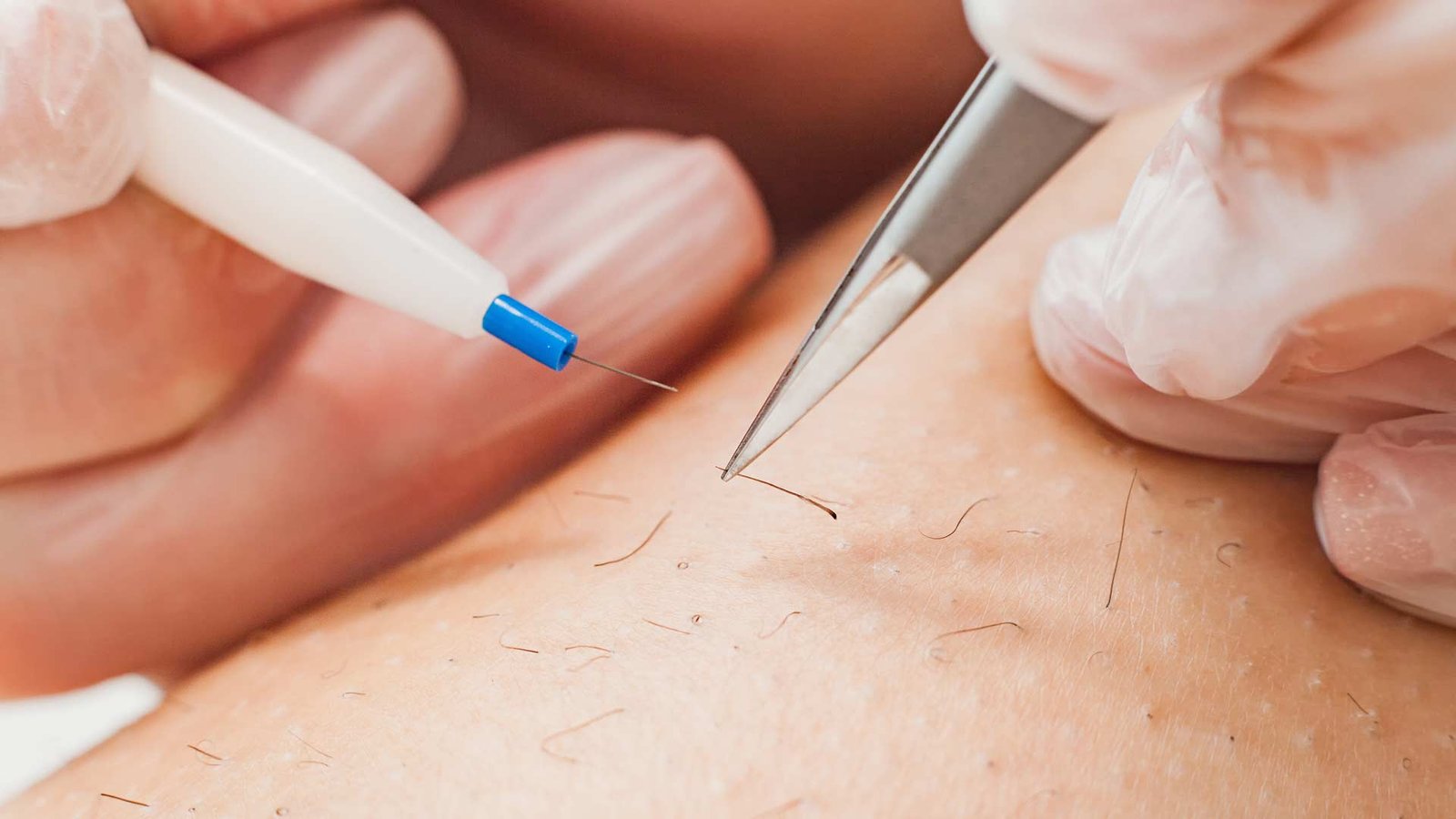 Clinical Electrolysis Treatment Oakville