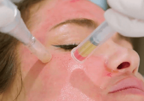 Platelet Rich Plasma (PRP) for Face Oakville Clinic